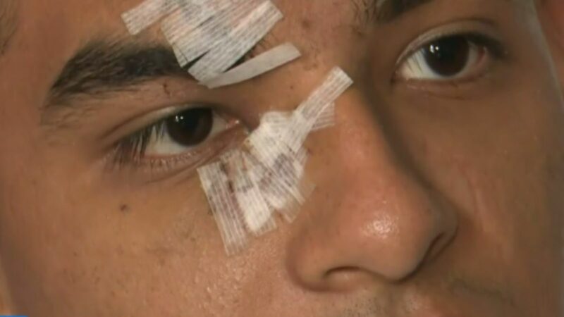 Estudiante David Díaz Quispe con puntos de sutura en el rostro tras agresión en la Universidad César Vallejo.