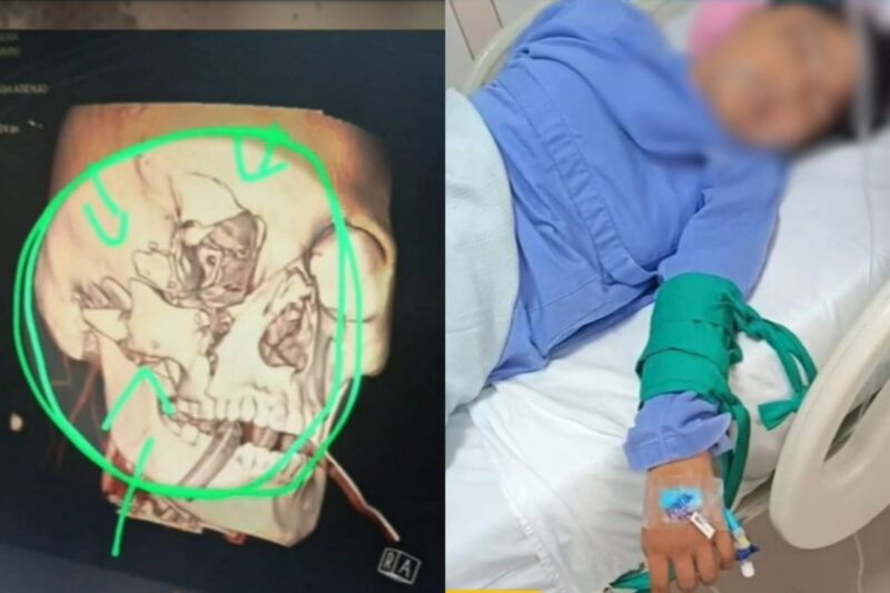 Joven de Chiclayo en coma tras sufrir graves fracturas en la cabeza por su pareja en tentativa de feminicidio.